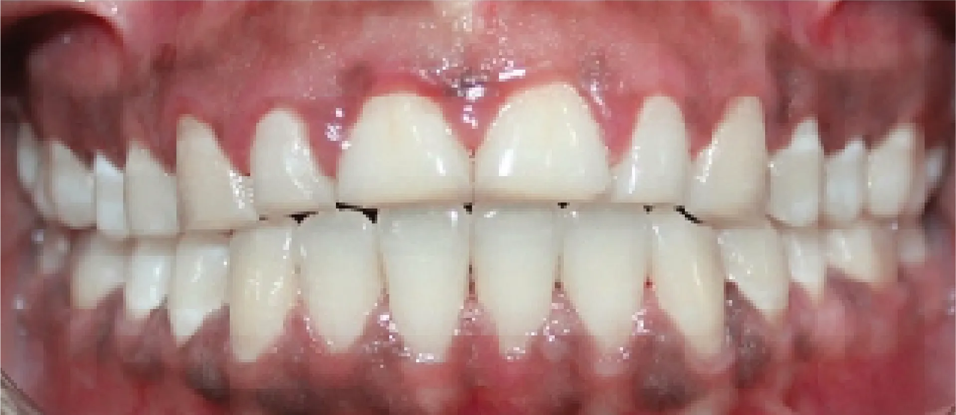 Straight, evenly-spaced teeth after treatment