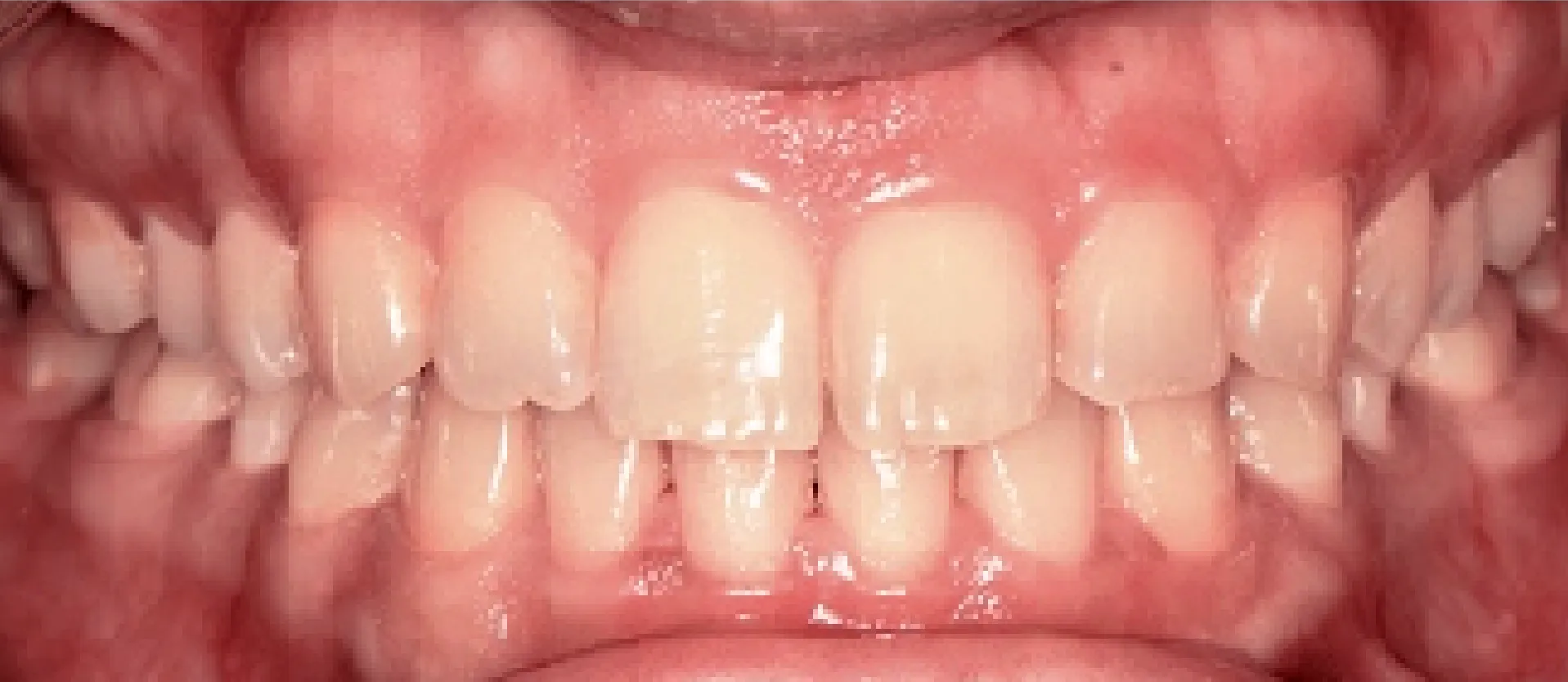 Bright, restored smile after treatment