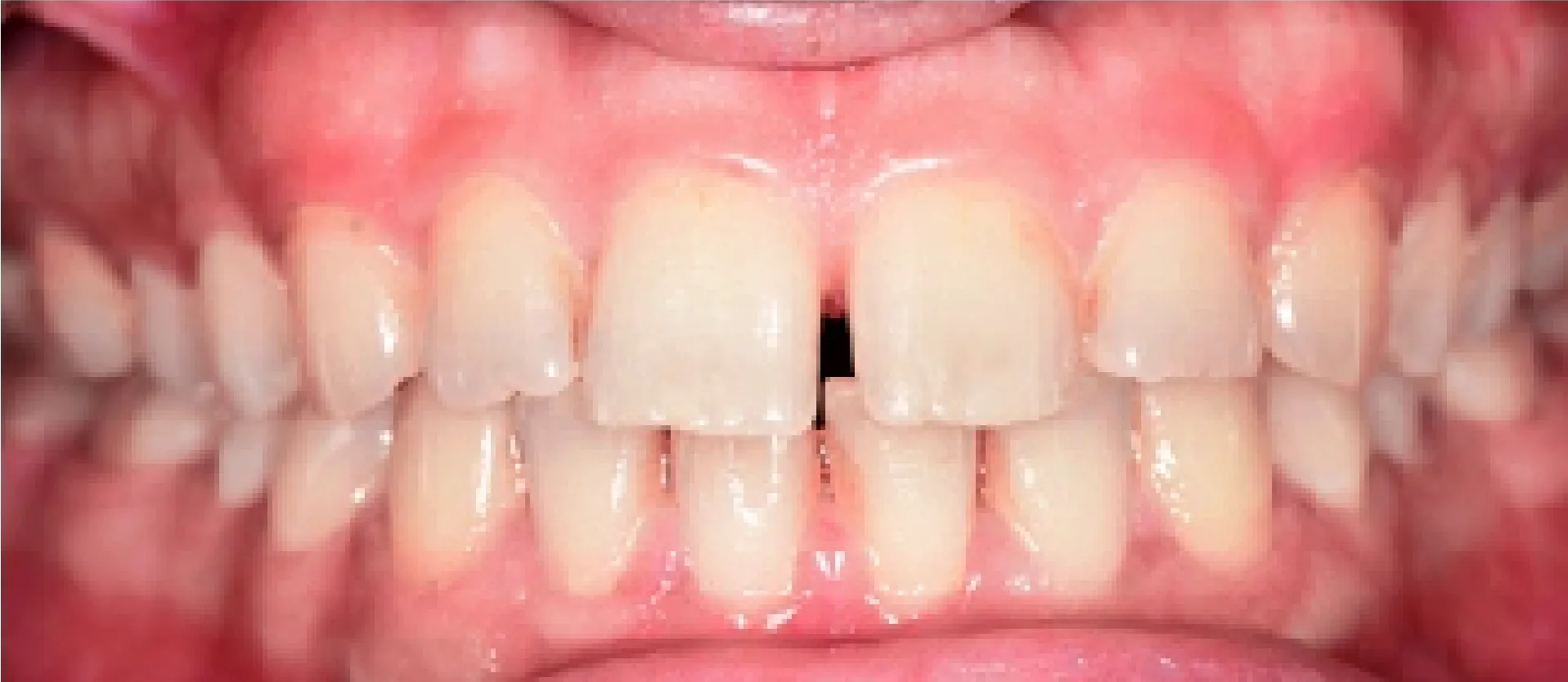 Discoloured and chipped teeth before treatment